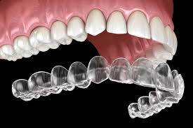 Clear Aligners