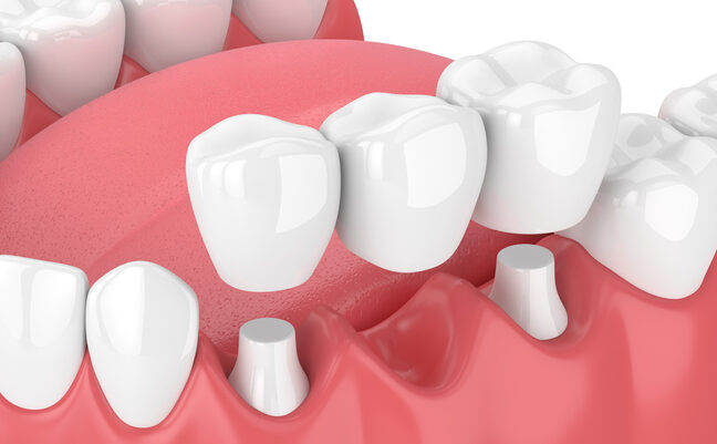 Dental Crowns