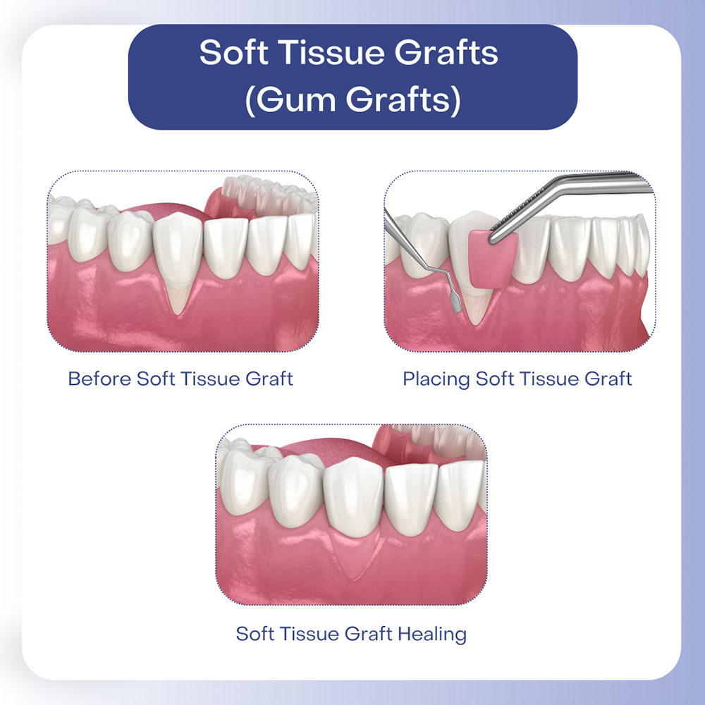 GumGraft