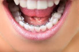 Lingual Aligners
