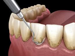 Dental Scaling