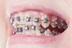 Self-Ligating Aligners