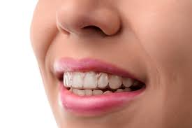 Teen Aligners