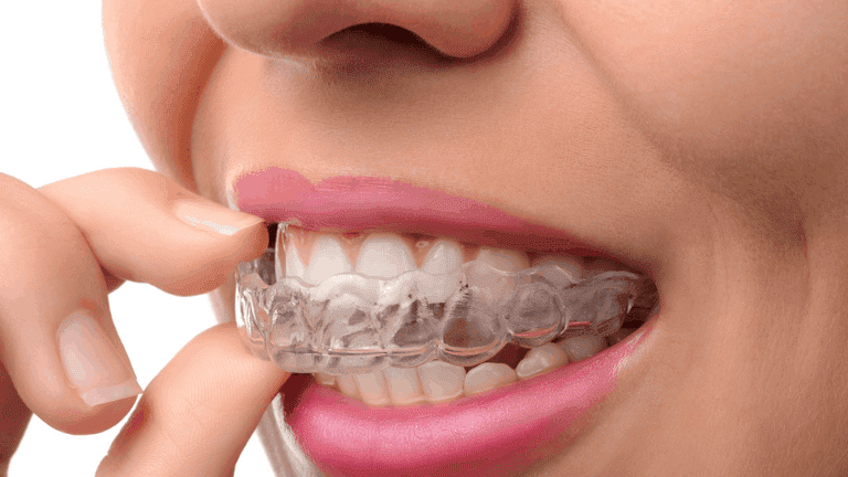 Invisible Dental Aligners