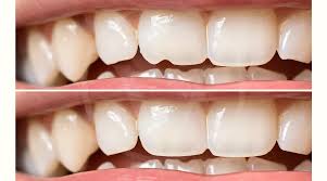 dental bonding