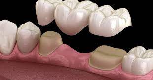 dental bridge