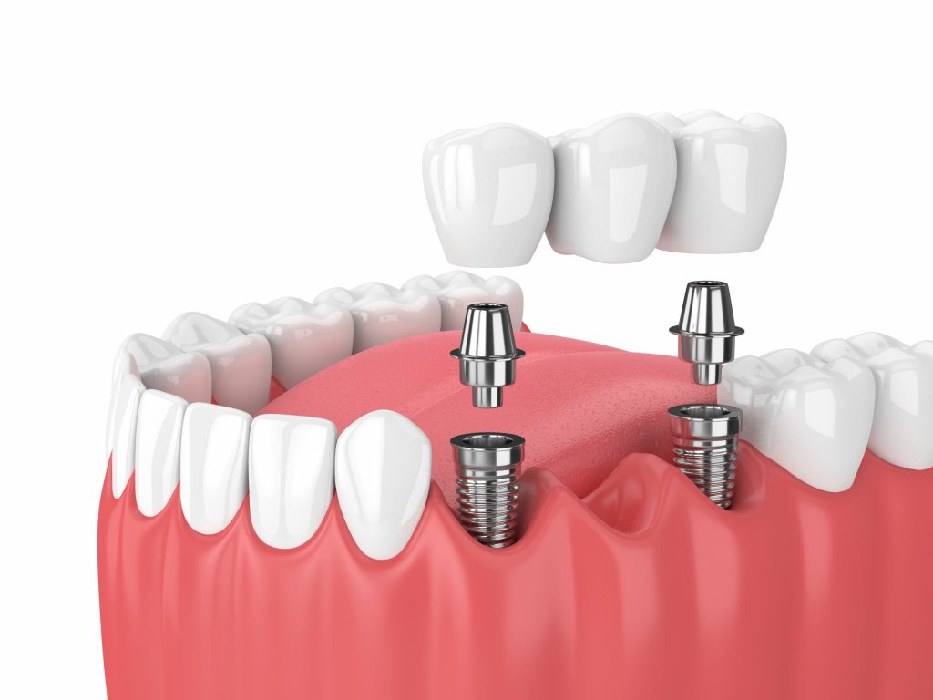 Dental Implants Image