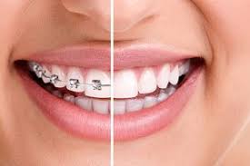 Hybrid Aligners