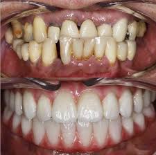 smile makeover