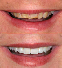 smile restoration