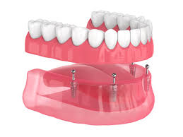 Dental Implants & Gum Support