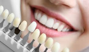 image of teeth and veneers