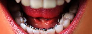 lingual braces image