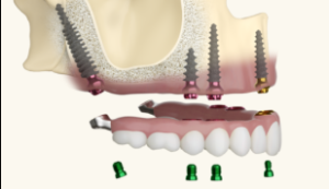 Pterygoid Implants