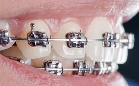 self ligating braces