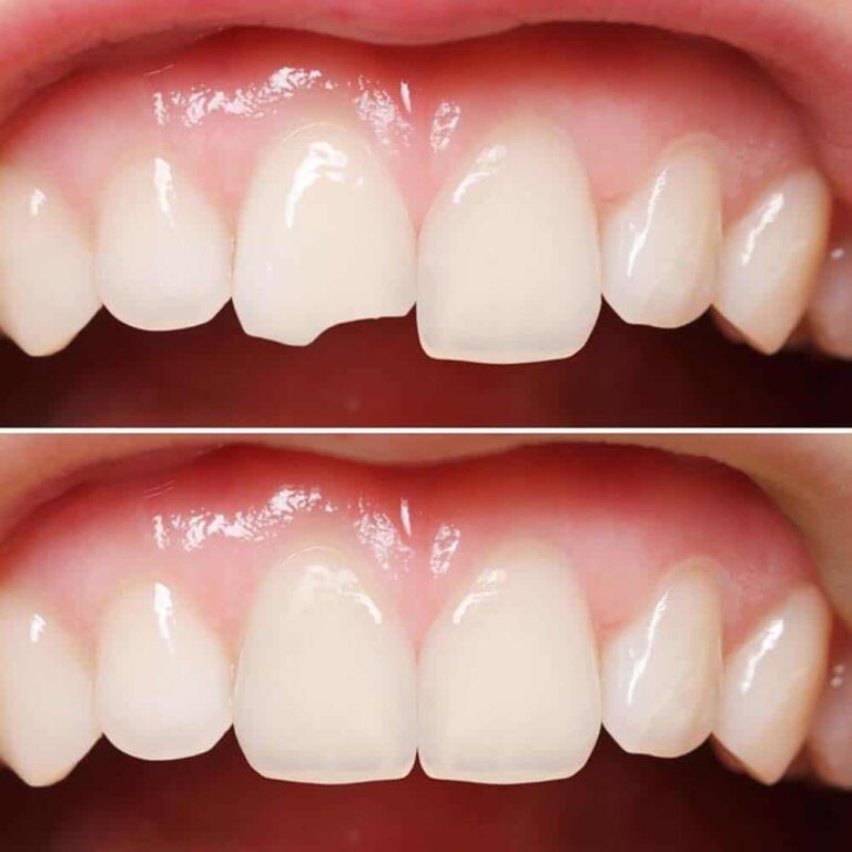 image of chipped tooth before and after