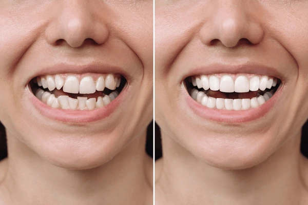 image of tooth before and after correction