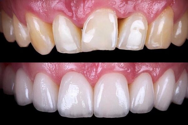 image of teeth before and after correction