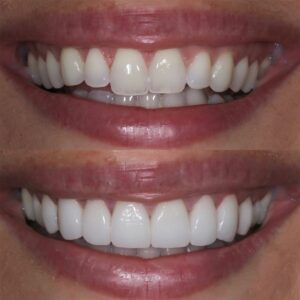 image of teeth before and after teeth correction