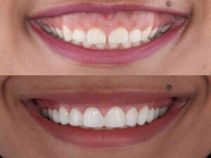 image of teeth before and after gum correction