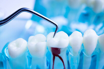 root canal treatment