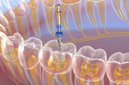 root canal treatment
