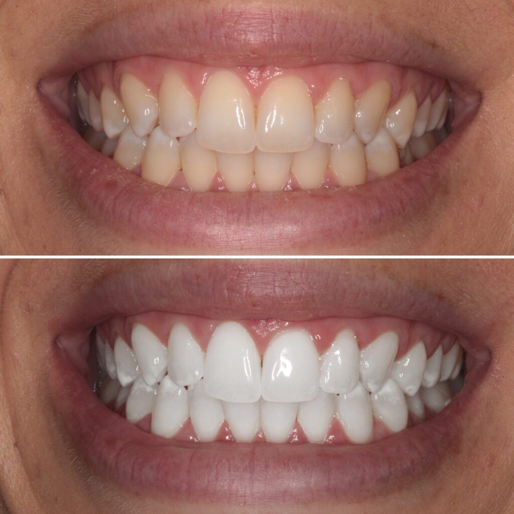 image of teeth before and after teeth whitening