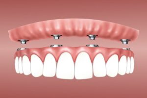 All on 4 Implants